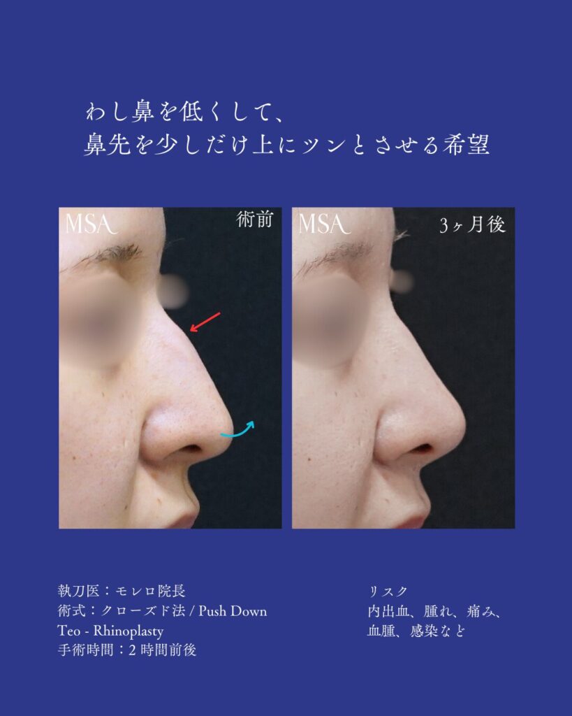 Rhinoplasty in Okinawa | 那覇市の美容クリニック MSA美容外科
